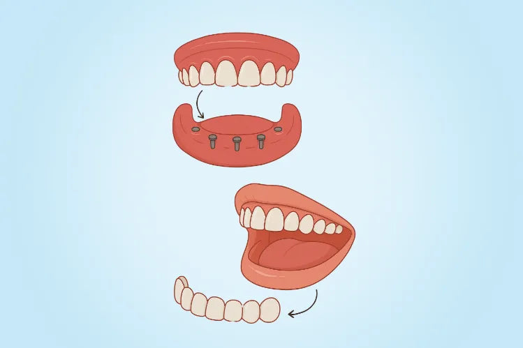 Abbildung von Snap-On-Veneers und Snap-On-Prothesen