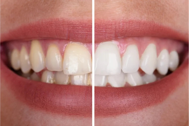 before and after teeth whitening.