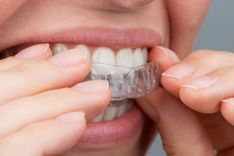 Ein Mädchen, das sich zu Hause durchsichtige Zahnschienen zur Zahnkorrektur anbringt.