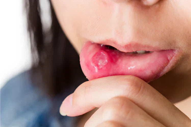 Eine Person, die Aphthen an der Lippeninnenseite aufweist.