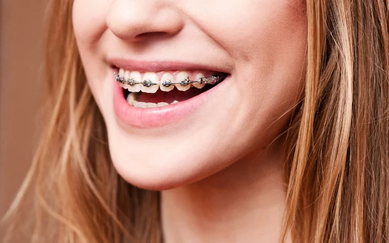  Ein Mädchen, das mit Zahnspangen aus Metall lächelt