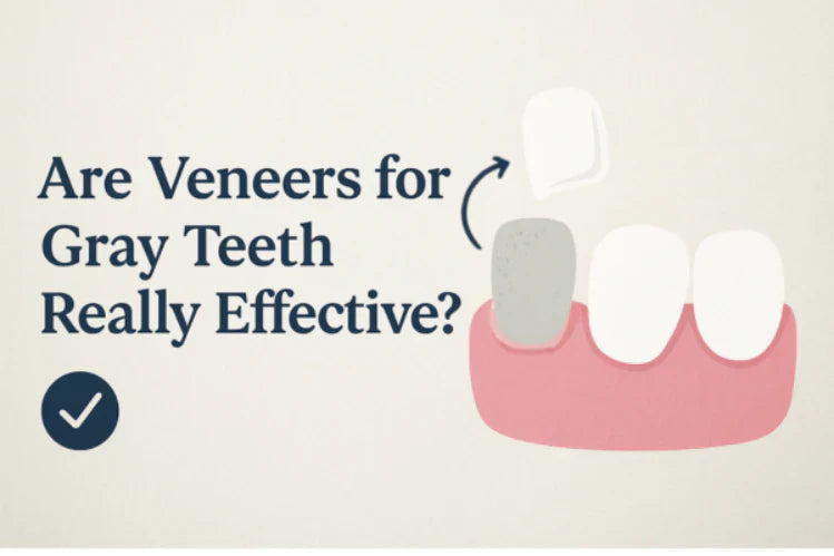 Illustration, die einen grauen Zahn zeigt, der mit einem Veneer überzogen wird.