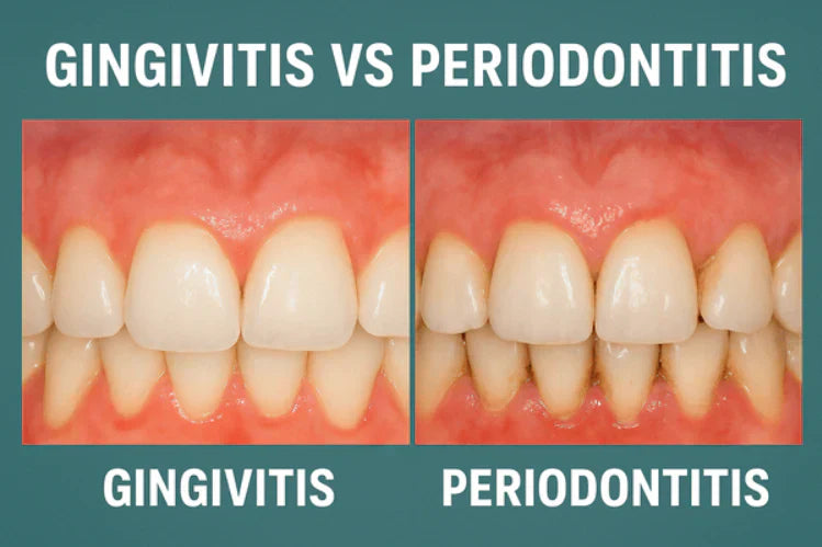 Direkter Vergleich von Gingivitis und Parodontitis