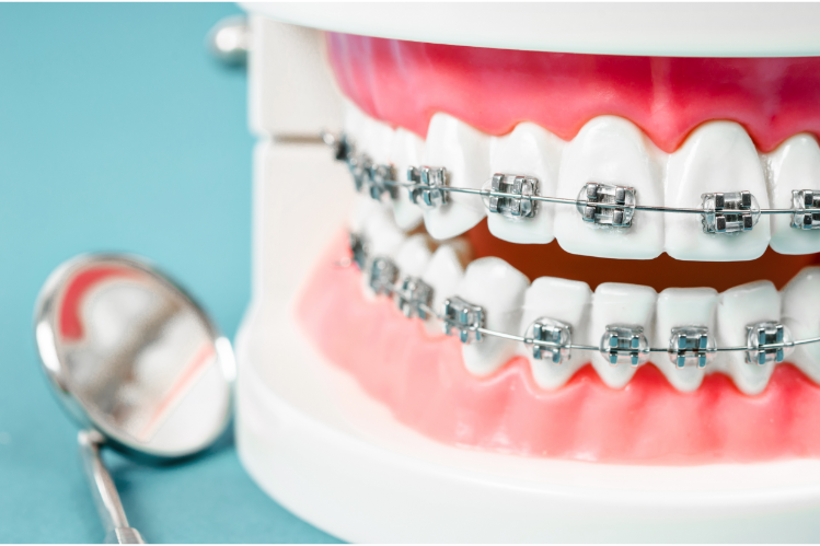 Zahnspangen brechen oder Schmerzen verursachen