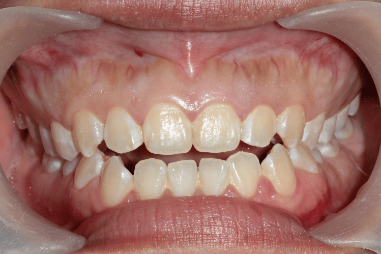 Type of Malocclusion