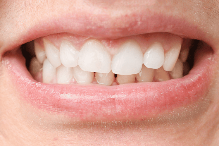 Teeth with malocclusion